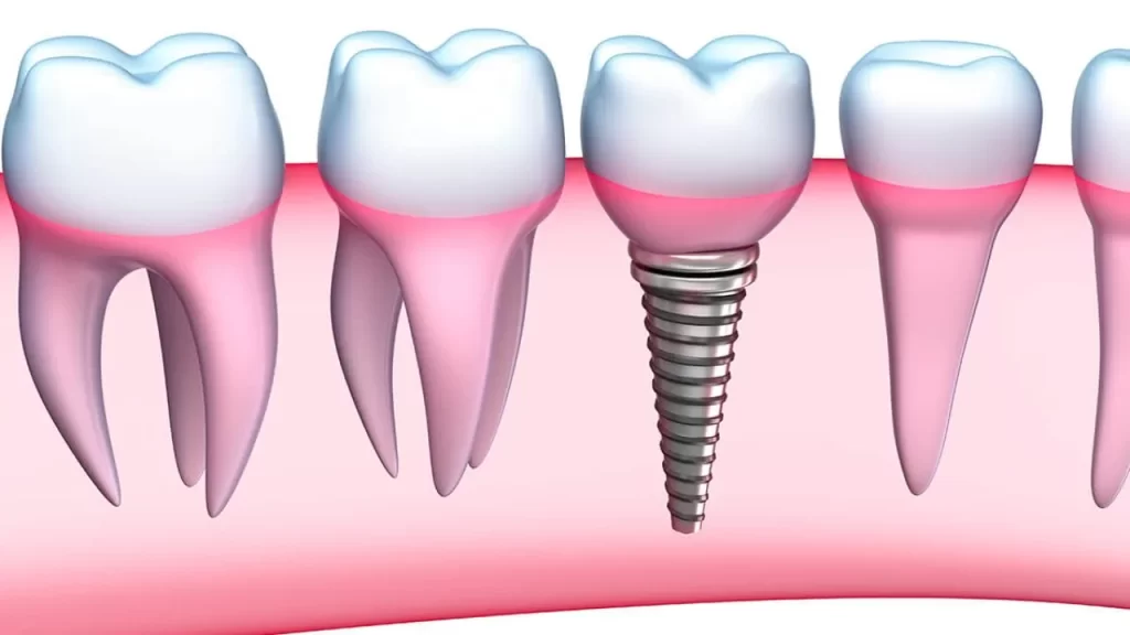 Mini Dental Implants: Are They Right for You?