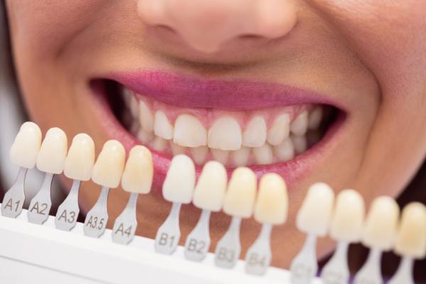 Dental Veneers