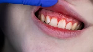 periodontal disease