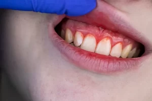 periodontal disease